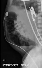 Graphical Abstract of Hirschsprung disease: current perspectives